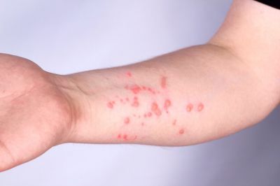 notícia: Mpox: Saiba quais os sintomas, como se prevenir e onde procurar atendimento em Ananindeua